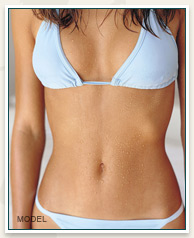 Liposuction Model Image